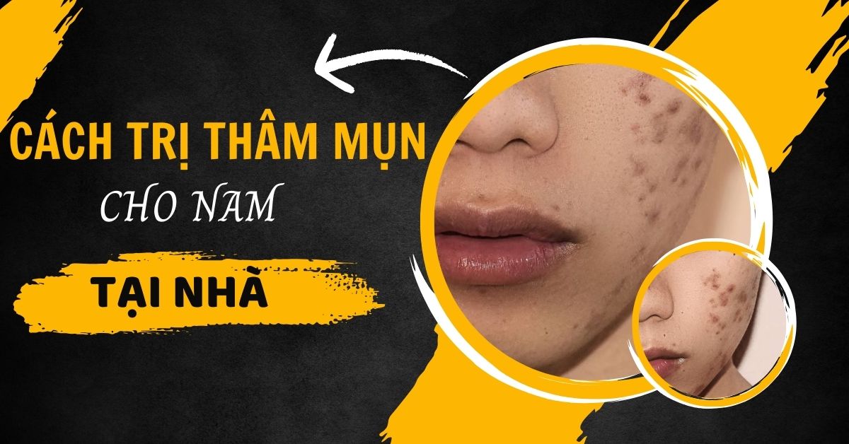 Cách trị thâm mụn cho nam tại nhà