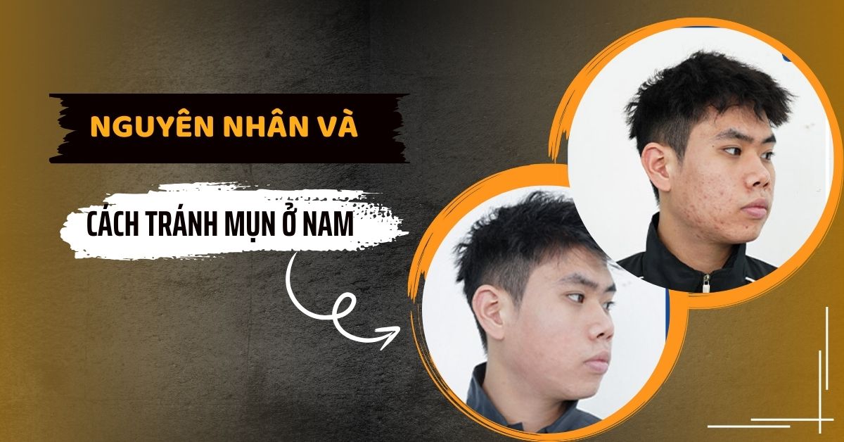 Cách tránh mụn ở nam