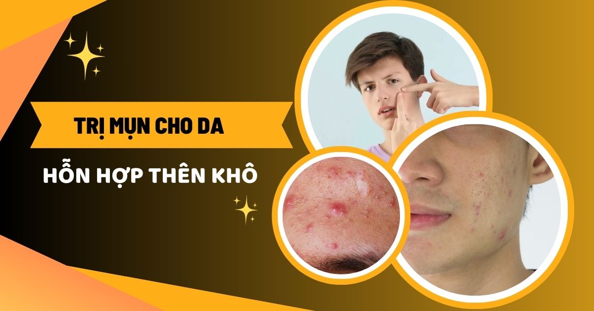 Trị mụn cho da hỗn hợp thiên khô