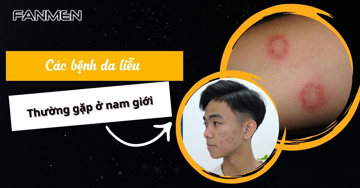 cac-benh-da-lieu-thuong-gap-o-nam-gioi