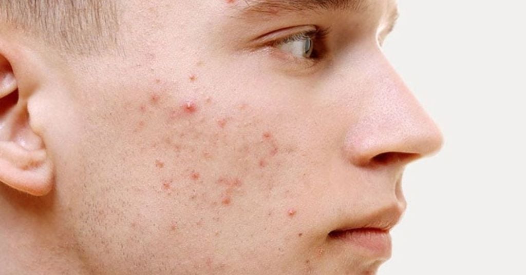 Vì Sao Nam Giới Nên Sử Dụng Sữa Rửa Mặt Trị Mụn Và Vết Thâm Cho Nam?