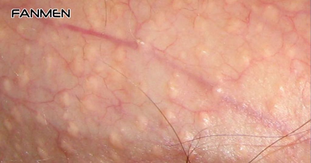 Nguyên Nhân Gây Nên Hạt Fordyce Ở Vùng Kín Nam