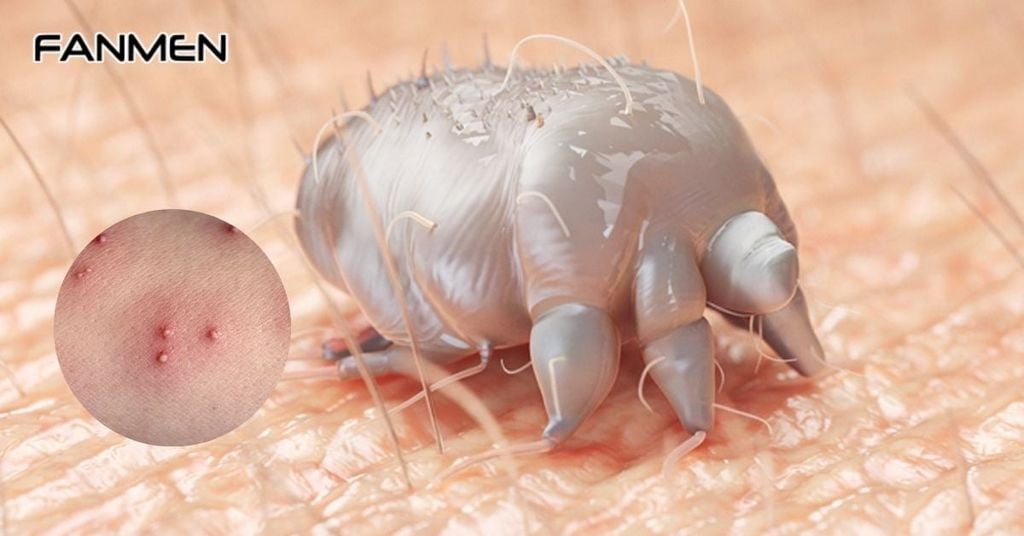 Bị ngứa và nổi mẩn đỏ ở vùng kín do bệnh ghẻ