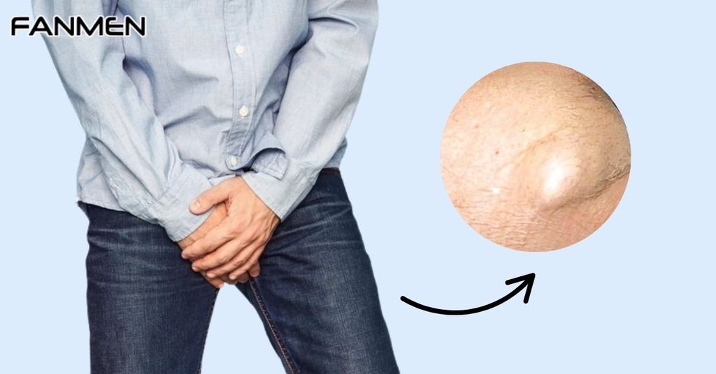 Biểu Hiện Nổi Hạch Ở Vùng Kín Nam