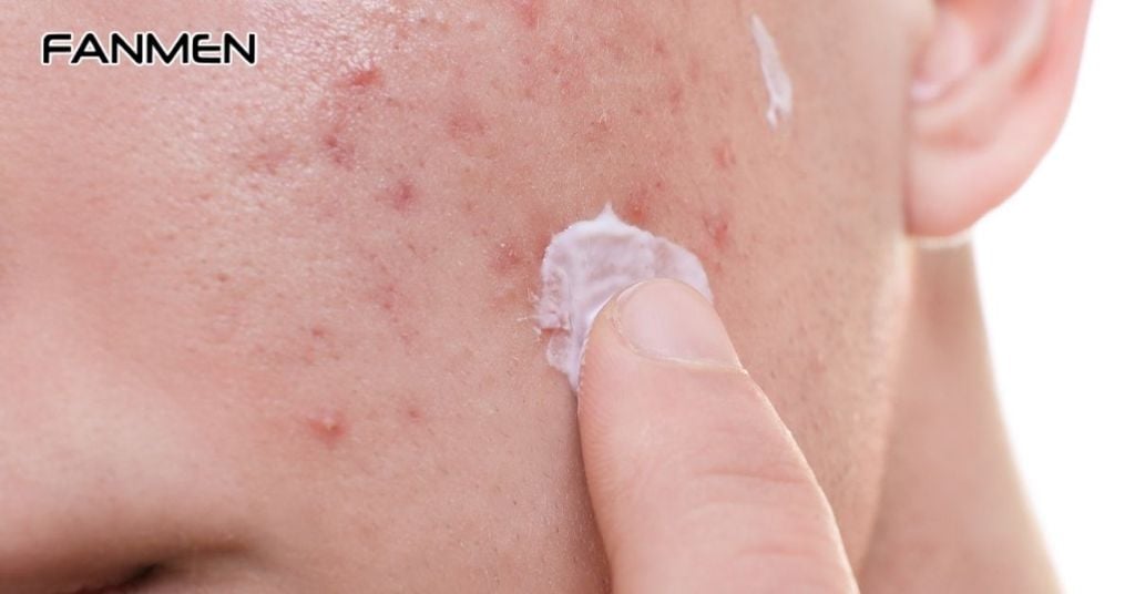 Trị mụn tuổi dậy thì cho nam bằng các sản phẩm chăm sóc da có thành phần trị mụn