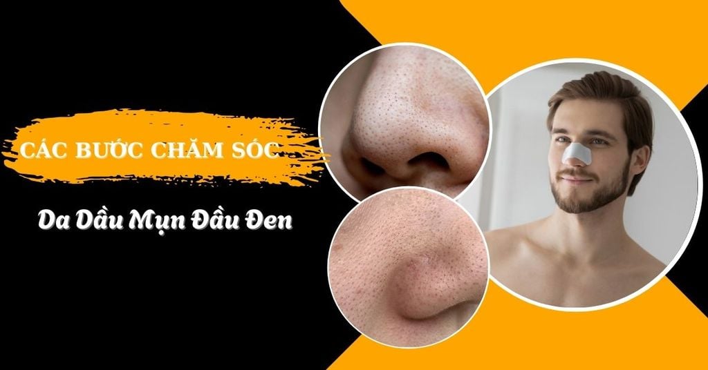 Các bước chăm sóc da dầu mụn đầu đen