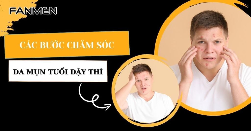các bước chăm sóc da mụn tuổi dậy thì