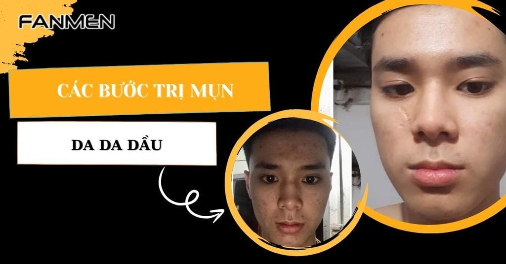 Các bước trị mụn cho da dầu