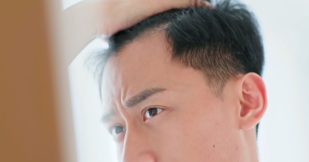 rụng tóc nhiều ở nam