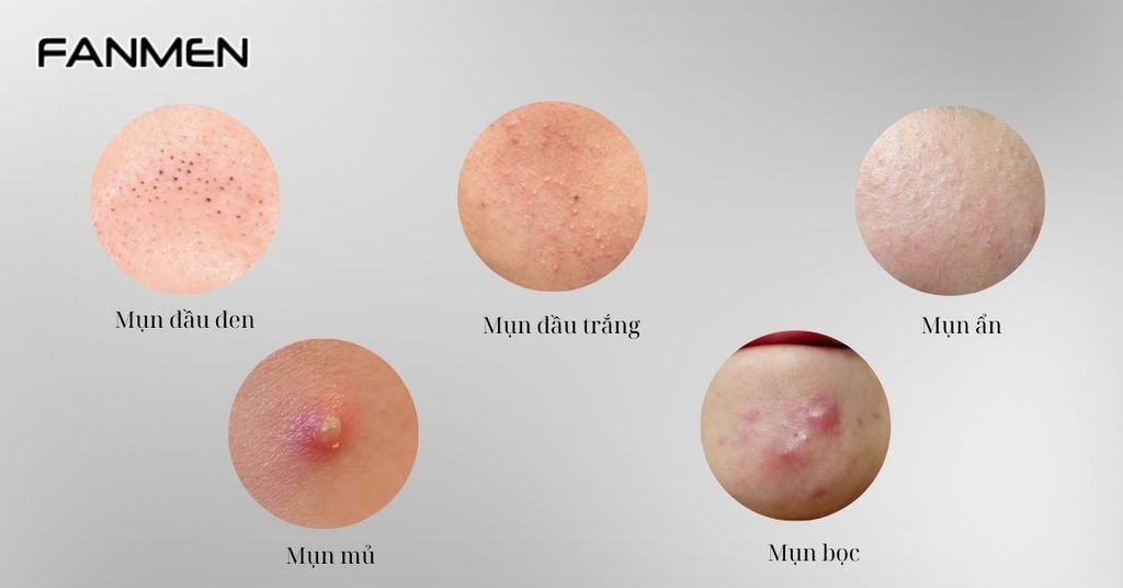 Các loại mụn thường gặp ở nam giới da nhờn