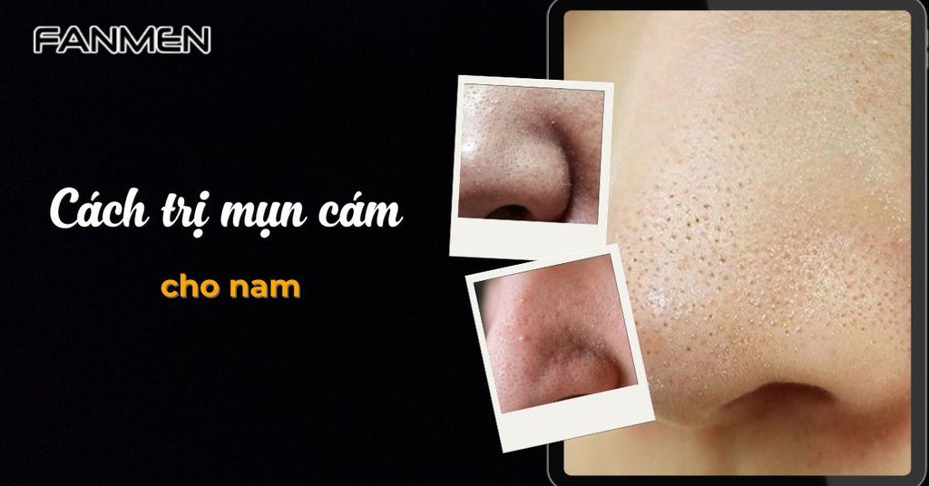 Cách trị mụn cám cho nam​