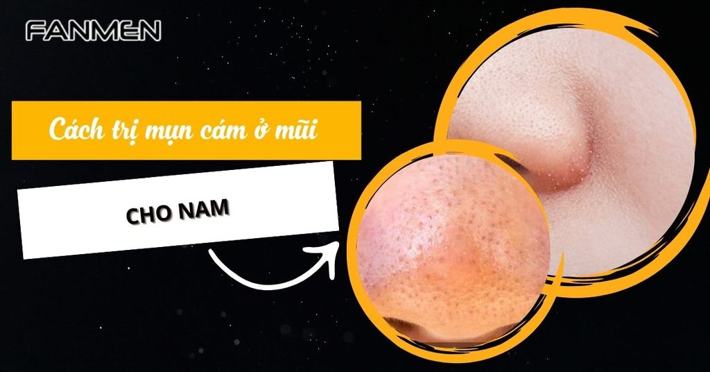 Cách trị mụn cám ở mũi cho nam