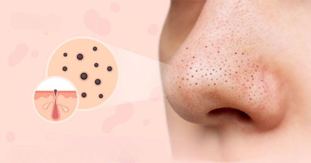 Cách trị mụn đầu đen hiệu quả