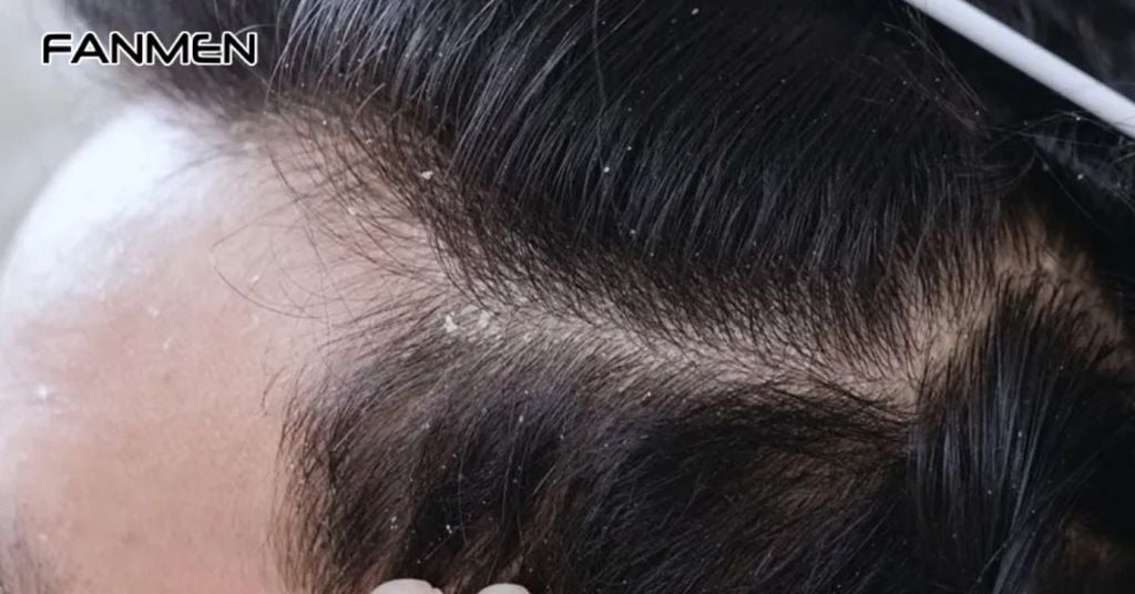 Hướng Dẫn Cách Lựa Chọn Dầu Gội Đầu Trị Gàu Cho Nam Giới