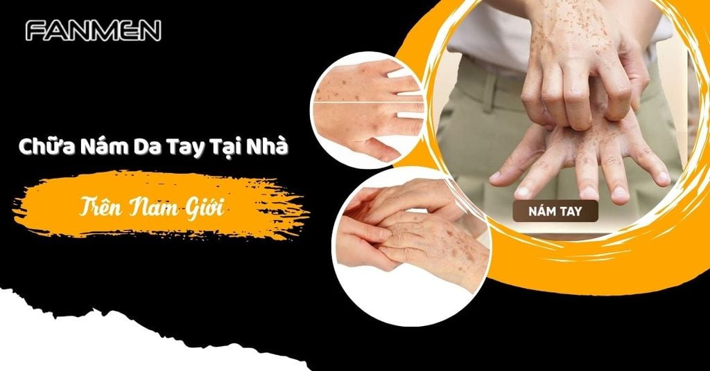 Chữa nám da tay tại nhà trên nam giới