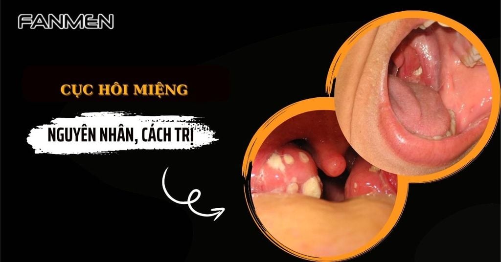 Cục hôi miệng