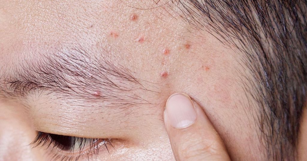 Da Dầu Mụn Là Gì?