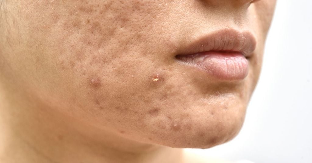 Da dầu mụn là gì