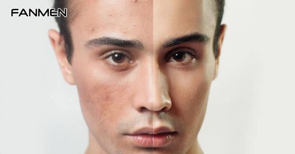 Da Dầu Mụn Là Gì?