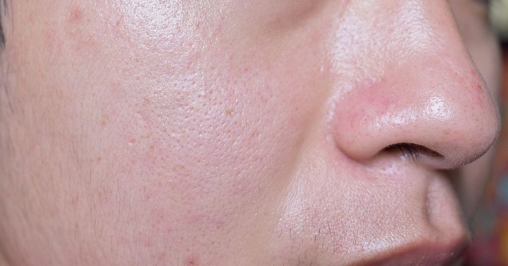 da dầu thiếu nước là làn da như thế nào