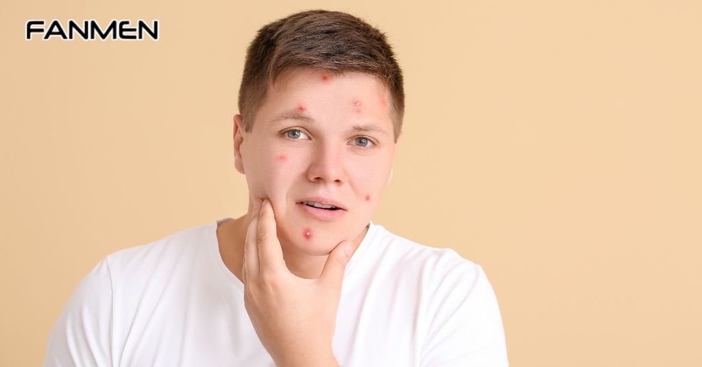 Da Dầu Mụn Tuổi Dậy Thì Ở Nam Giới Là Gì?