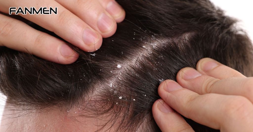 Dầu gội trị gàu cho nam