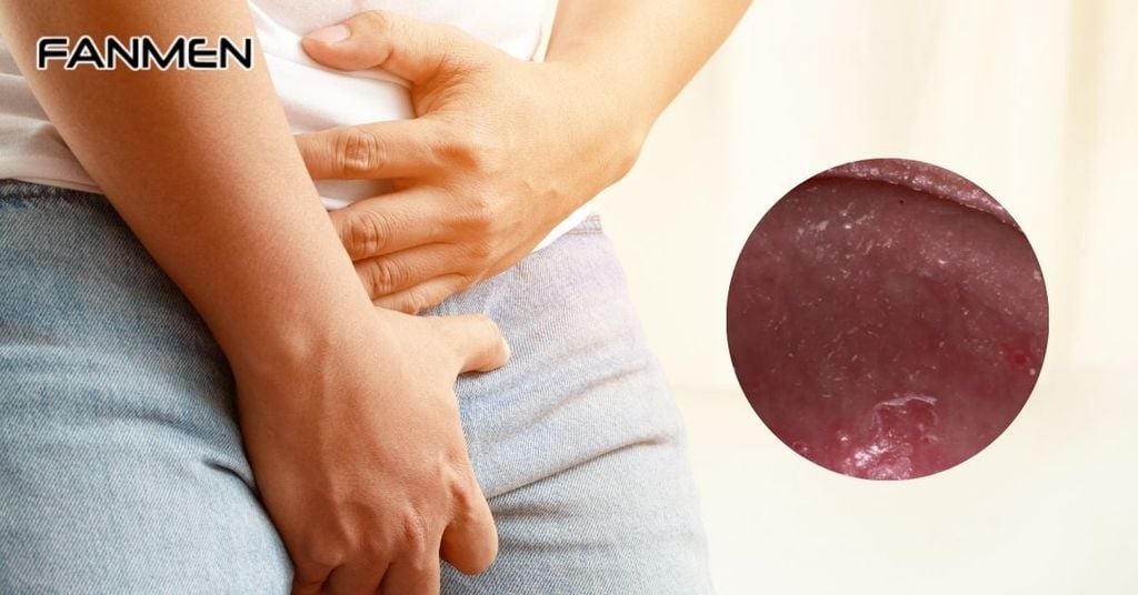 Dấu hiệu nhận biết nhiễm nấm vùng kín ở nam giới