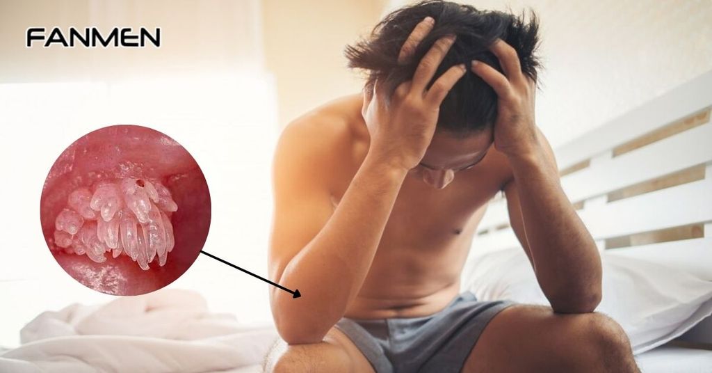Dấu hiệu sùi mào gà ở nam giới