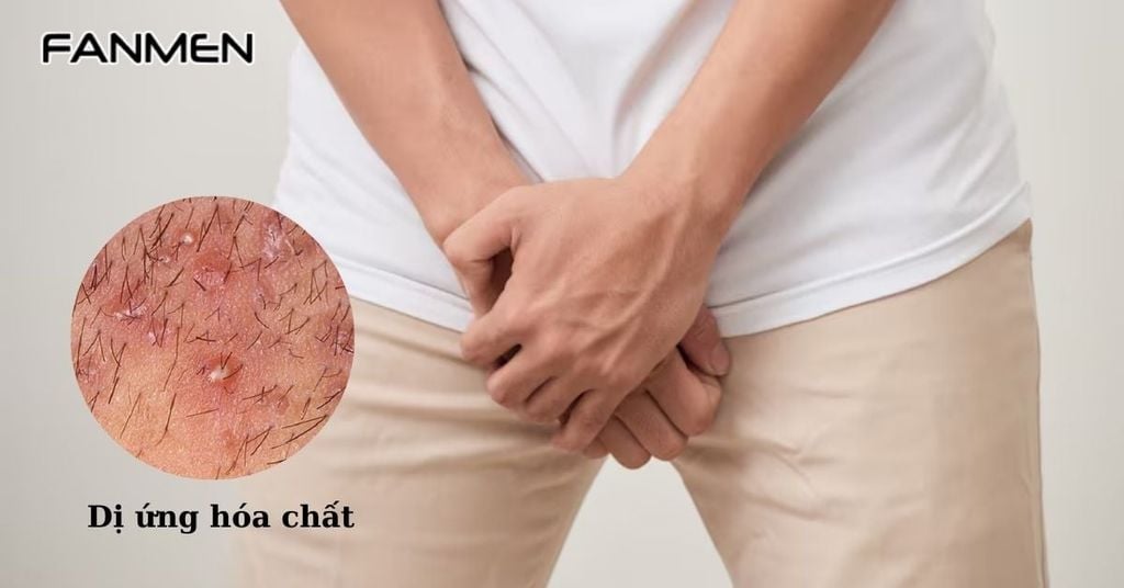 Mụn vùng kín nam do dị ứng hóa chất