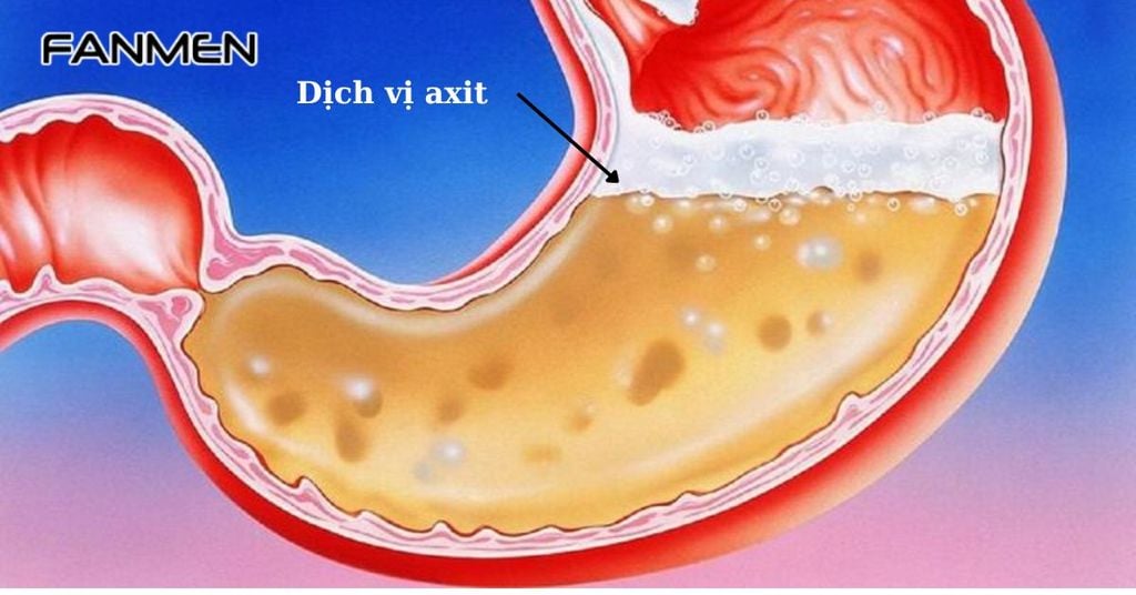 Dịch vị acid trào ngược&nbsp;lên miệng