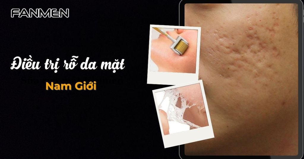 Điều trị rỗ da mặt nam giới