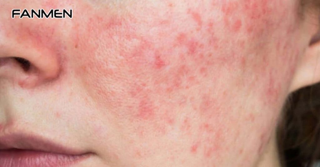 Nguyên Nhân Gây Nên Tình Trạng Da Nhạy Cảm Ở Nam Và Nữ