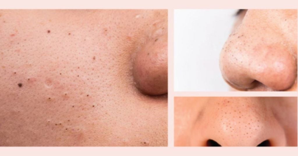 Lợi Ích Khi Sử Dụng Sữa Rửa Mặt Trị Mụn Đầu Đen Cho Nam