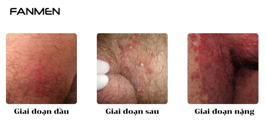 Giai đoạn bệnh hắc lào ở vùng kín nam