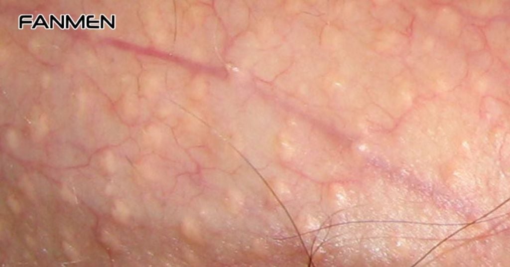 Hạt bã nhờn (Fordyce Spot)