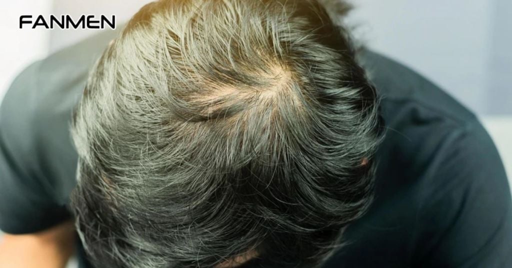 Tiêu Chí Khi Lựa Chọn Dầu Gội Cho Nam Tóc Mỏng