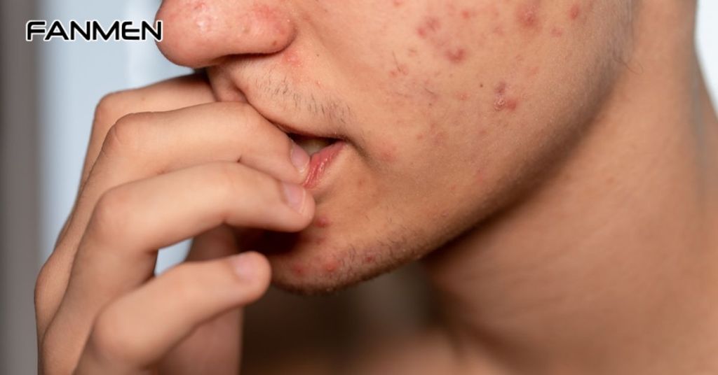 Lưu Ý Khi Sử Dụng Kem Trị Mụn Thâm Việt Nam