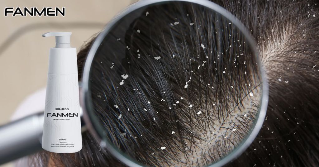 Lựa chọn dầu gội phù hợp với tóc gàu