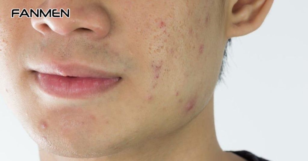 Lưu Ý Khi Trị Thâm Mụn Cho Nam Giới