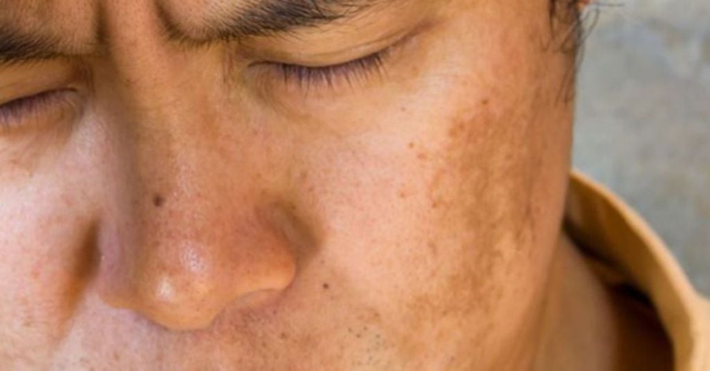 Nám Da Ở Nam Giới Nguyên Nhân Là Do Đâu?