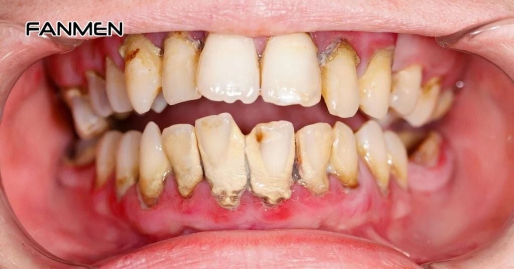 Mảng bám, vôi răng và nha chu