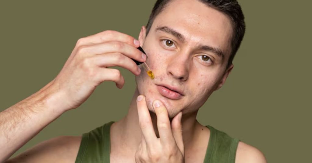Cách Trị Thâm Mụn Cho Nam Tại Nhà