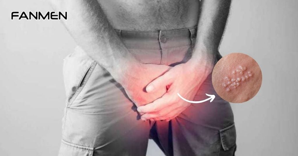 Mụn cóc sinh dục