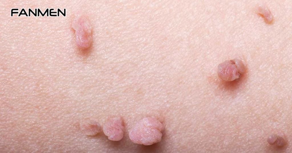 Mụn cóc sinh dục