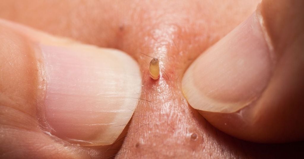 Các Bước Chăm Sóc Da Mụn Đầu Đen