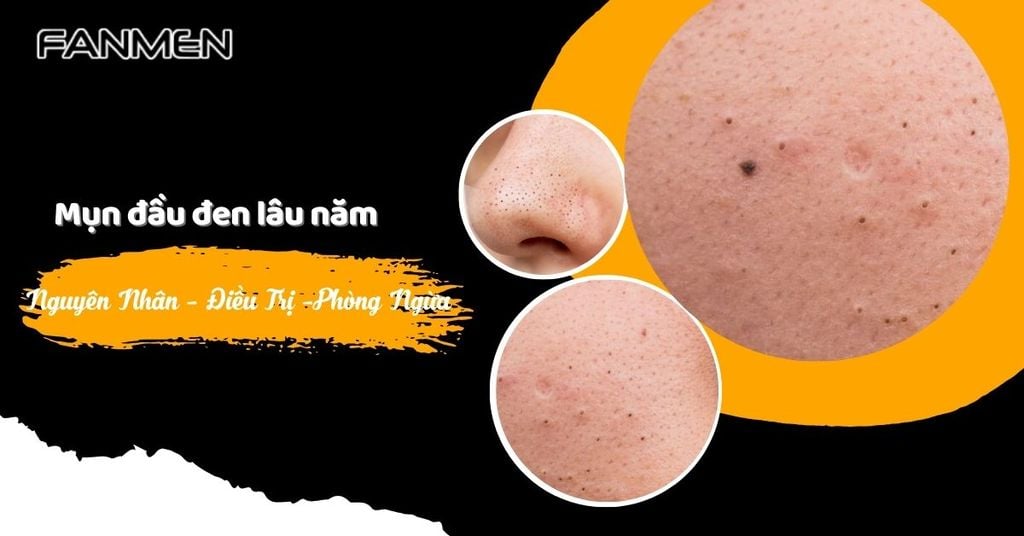 Mụn đầu đen lâu năm