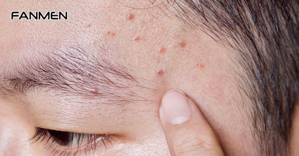 Mụn mọc ở thái dương