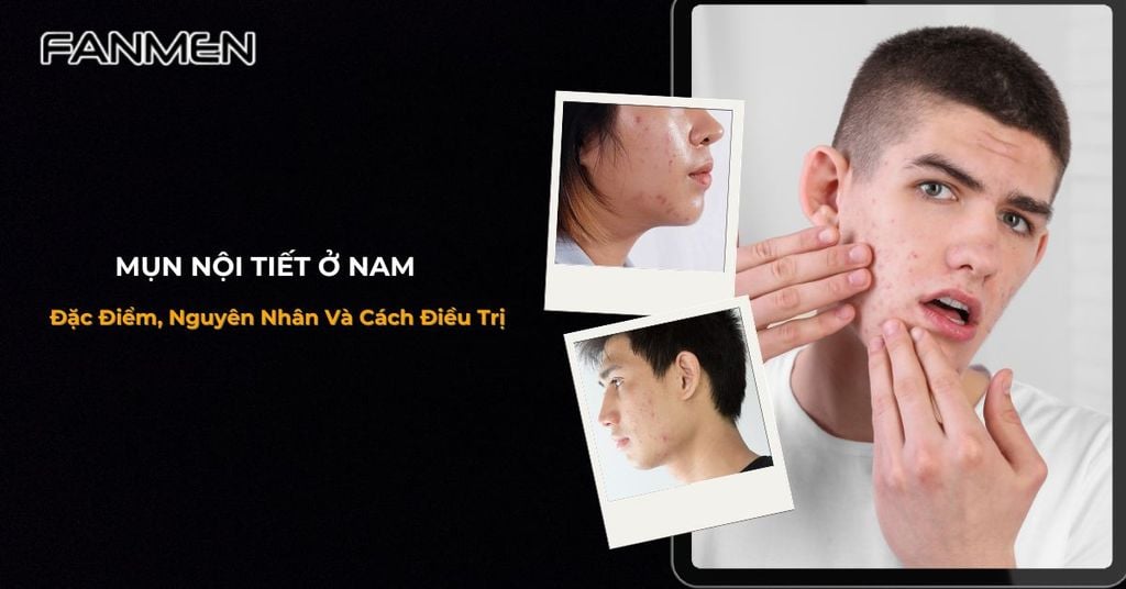 mụn nội tiết ở nam
