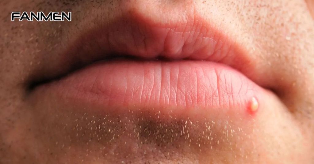 Mụn mọc ở vị trí quanh miệng