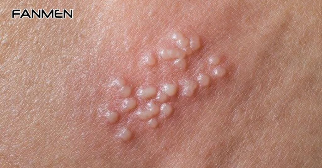 Mụn rộp sinh dục